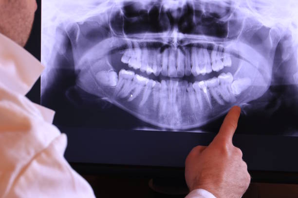 Best Emergency Wisdom Teeth Removal in New Bedford, PA